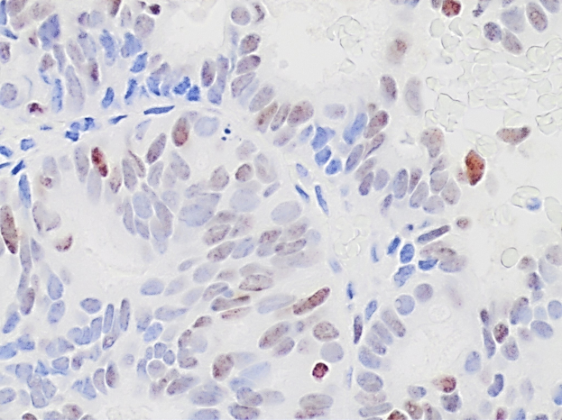 Mikroskopisches Bild eines gefärbten Lymphozyten in der Mitte eines humanen Gewebeschnitts.